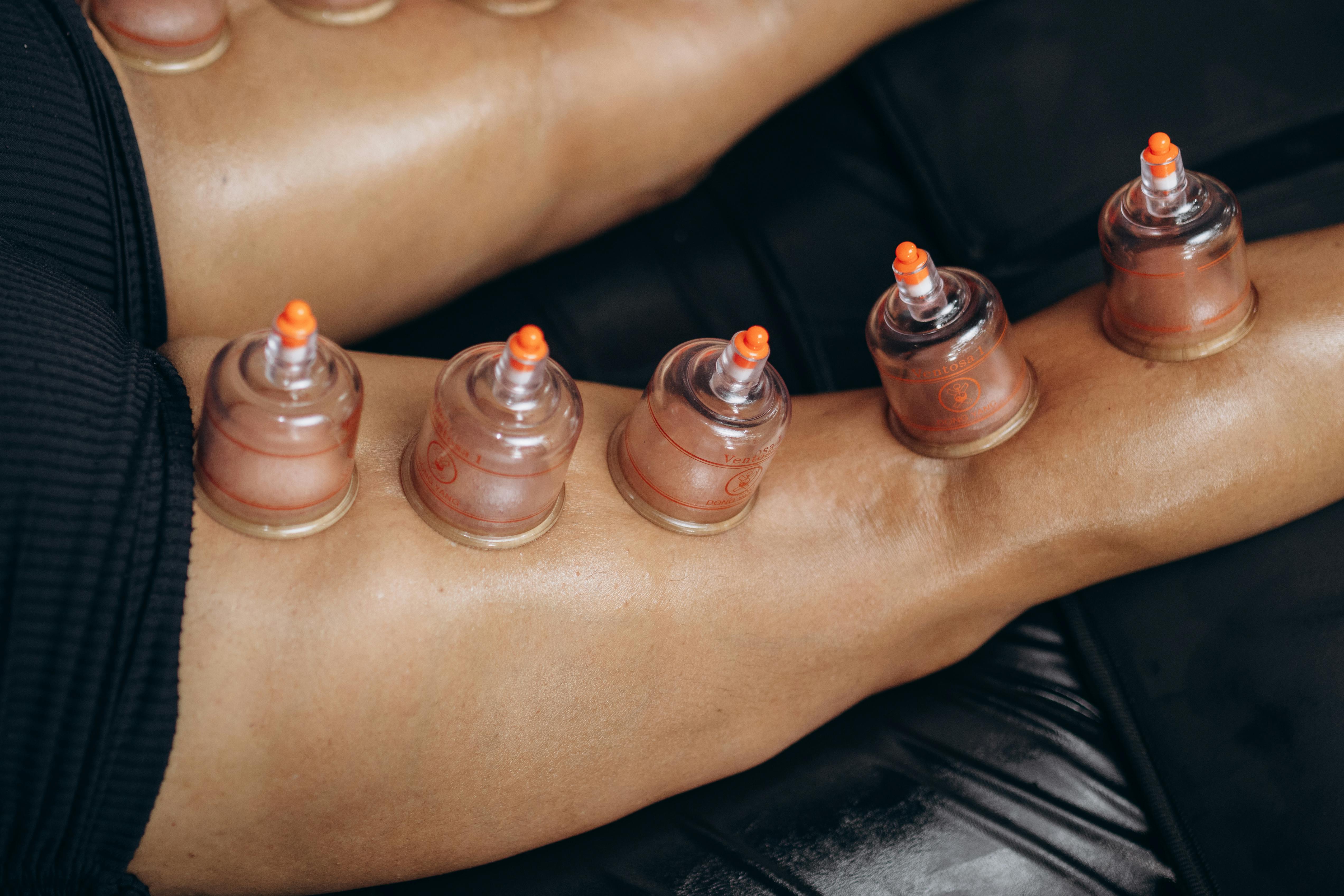 Cupping Terapy